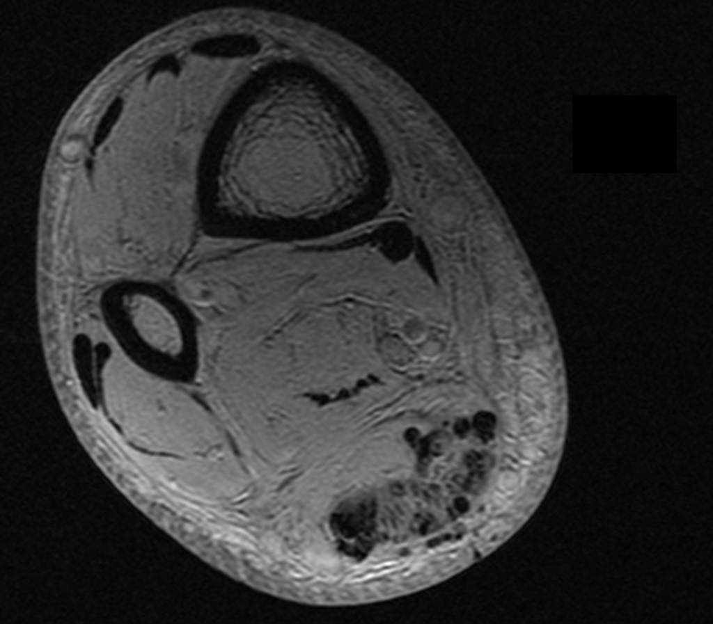 Tissue Edema (TisE) - Smarter Diagnostics